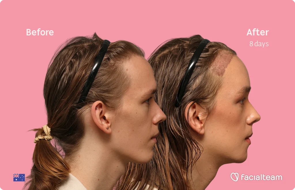 Side-by-side profile of a woman showing 'Before' and 'After 8 days' hairline change on a pink background; branding: facia lteam in bottom right.