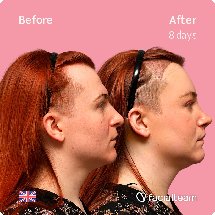 Side-by-side profile photos of a woman before and after a treatment, showing a slimmer jawline after 8 days on a pink background.