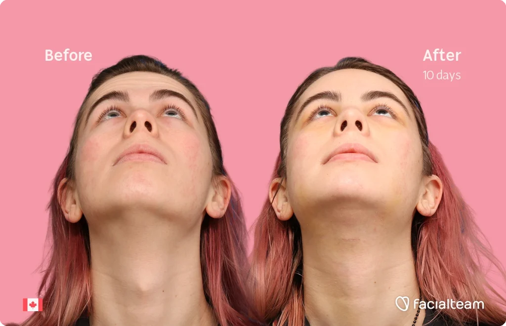 Side-by-side before and after photo of a woman's chin and neck, pink background, 'Before' on left and 'After 10 days' on right, Facalteam logo bottom right, Canadian flag bottom left
