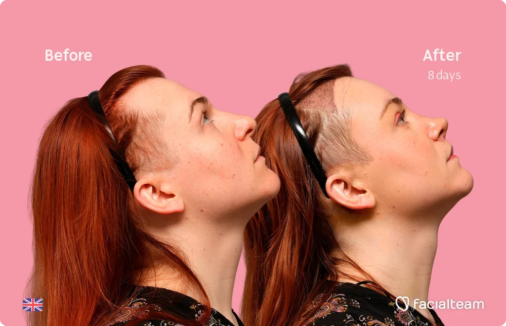 Side-by-side profile of a red-haired person before (left) and after 8 days (right) against a pink background; branding note at bottom right says 'facialteam'