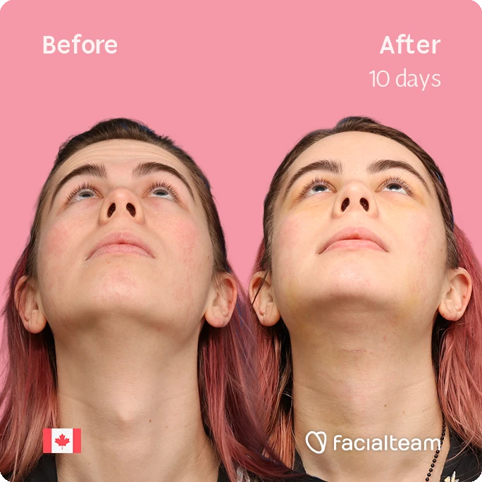 Two-panel comparison of a woman's face and neck; left labeled Before, right After 10 days, showing smoother skin and improved jawline; pink background with Facialteam logo and Canadian flag
