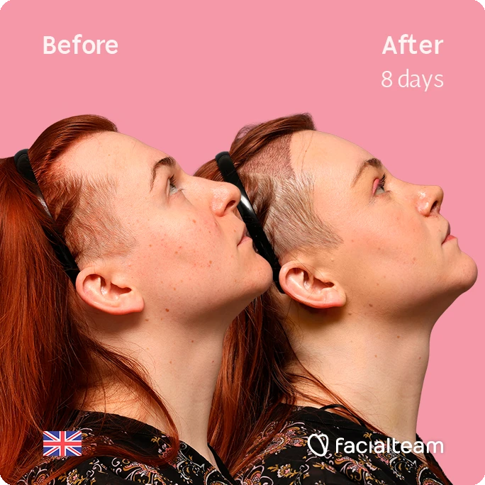 Side-by-side profile of a woman before (left) and after eight days of a facial treatment, pink background, watermark facialteam.